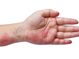 ANTISARNA Y GARRAPATAS 10 ml "CHICA VERNO TUPE"